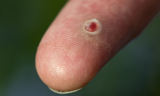 PYOGENT GRANULOM: Ufarlig, lettblødende, liten svulst bestående av små blodårer i huden. Kan tilkomme etter traume på huden. FOTO: NTB scanpix / Shutterstock / Claudio Divizia PYOGENT GRANULOM: Ufarlig, lettblødende, liten svulst bestående av små blodårer i huden. Kan tilkomme etter traume på huden. FOTO: NTB scanpix / Shutterstock / Claudio Divizia